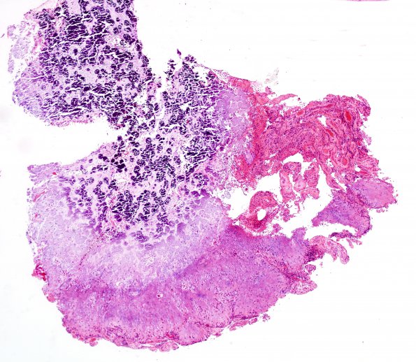 1B8 Calcifying Pseudoneoplasm Neuraxis (Case 1) H&E 1