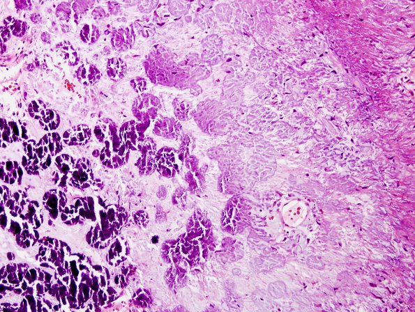 1B9 Calcifying Pseudoneoplasm Neuraxis Case 1) H&E 3