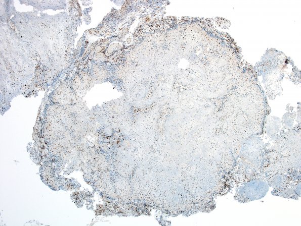 1C1 Calcifying Pseudoneoplasm Neuraxis (Case 1) CD68 13.jpg