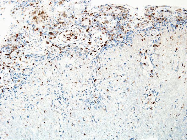 1C2 Calcifying Pseudoneoplasm Neuraxis (Case 1) CD68 10.jpg