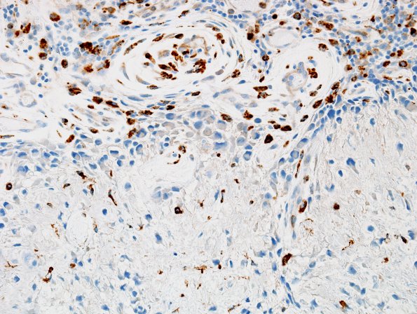 1C3 Calcifying Pseudoneoplasm Neuraxis (Case 1) CD68 1 (2).jpg