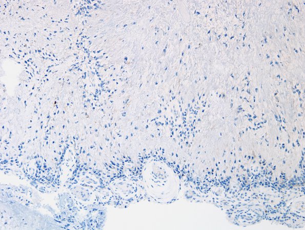 1D Calcifying Pseudoneoplasm Neuraxis (Case 1) EMA.jpg