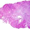 2A1 Calcifying Pseudoneoplasm Neuraxis (Case 2) H&E WM.jpg