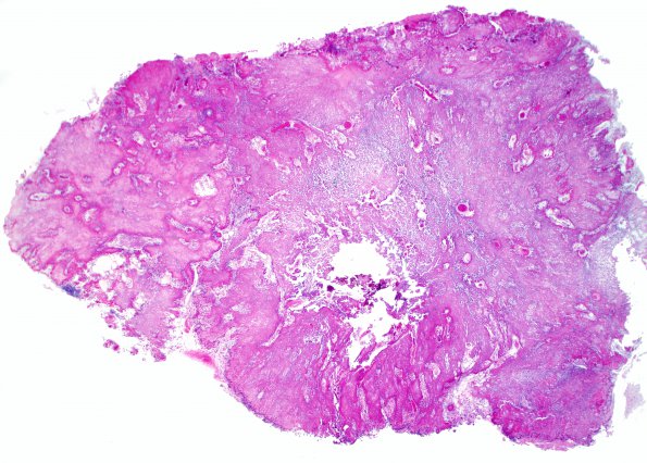 2A1 Calcifying Pseudoneoplasm Neuraxis (Case 2) H&E WM.jpg