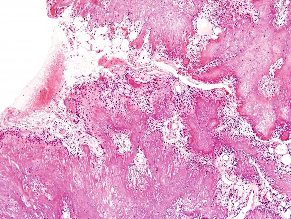 2A2 Calcifying Pseudoneoplasm Neuraxis (Case 2) H&E 1