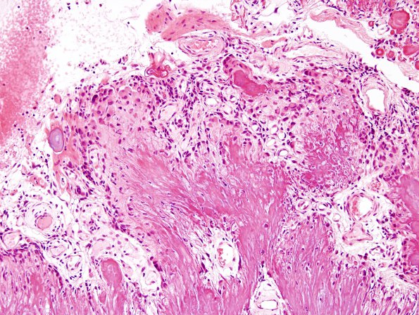 2A3 Calcifying Pseudoneoplasm Neuraxis (Case 2) H&E 3