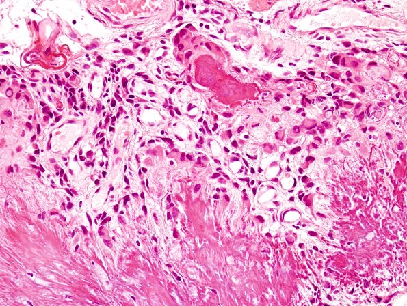 2A4 Calcifying Pseudoneoplasm Neuraxis (Case 2) H&E 2