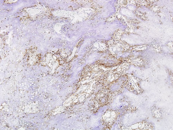 2B2 Calcifying Pseudoneoplasm Neuraxis (Case 2) EMA 3