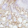 2B3 Calcifying Pseudoneoplasm Neuraxis (Case 2) EMA 1