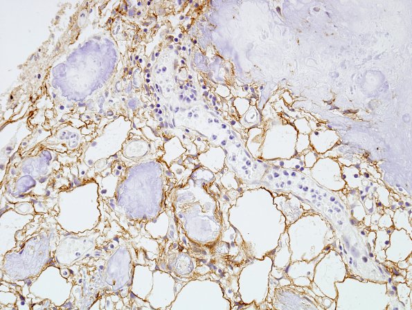 2B3 Calcifying Pseudoneoplasm Neuraxis (Case 2) EMA 1