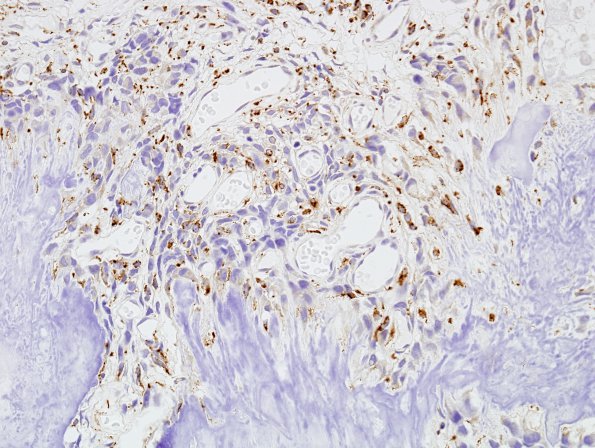 2C2 Calcifying Pseudoneoplasm Neuraxis (Case 2) CD68 1