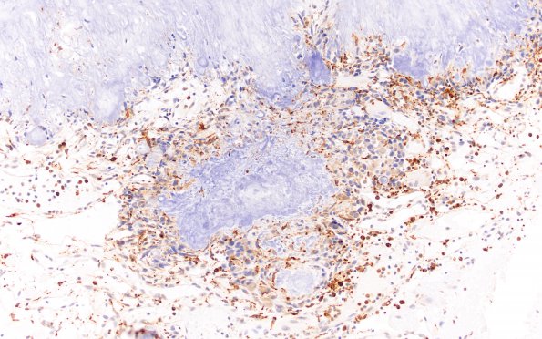 2C3 Calcifying Pseudoneoplasm Neuraxis (Case 2) CD68 20X