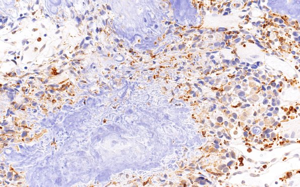 2C4 Calcifying Pseudoneoplasm Neuraxis (Case 2) CD68 40X