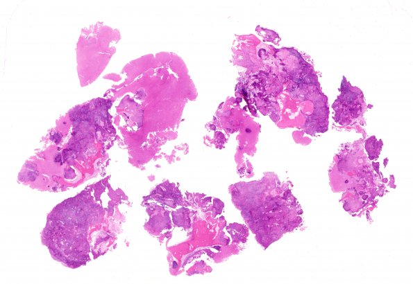 3A1 Calcifying Pseudoneoplasm Neuraxis (2009 CANP Unknown #12) H&E WM