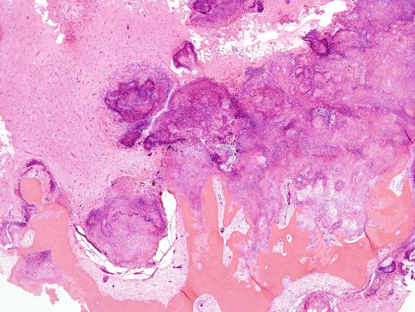 3A2 Calcifying Pseudoneoplasm Neuraxis (2009 CANP Unknown 12) H&E 6