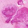 3A3 Calcifying Pseudoneoplasm Neuraxis (2009 CANP Unknown 12) H&E 5