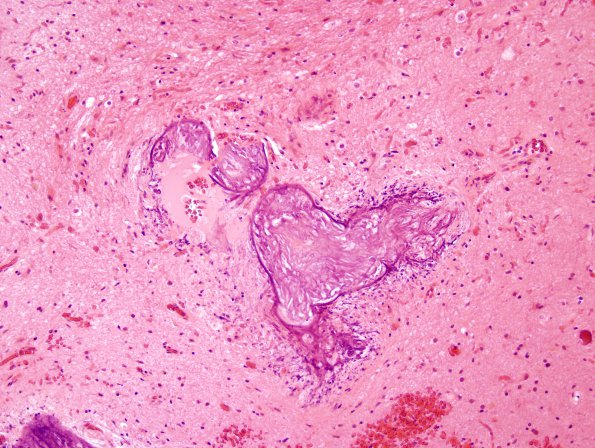 3A4 Calcifying Pseudoneoplasm Neuraxis (2009 CANP Unknown 12) H&E 10