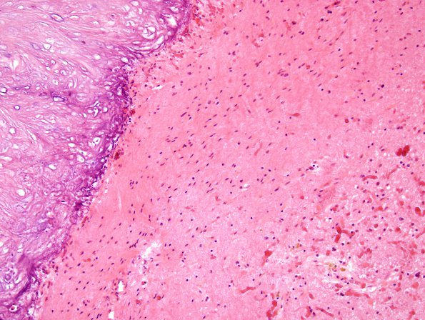 3A5 Calcifying Pseudoneoplasm Neuraxis (2009 CANP Unknown 12) H&E 2