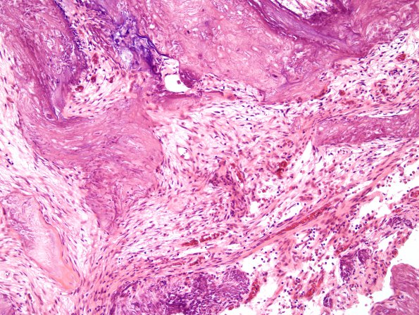 3A6 Calcifying Pseudoneoplasm Neuraxis (2009 CANP Unknown 12) H&E 3