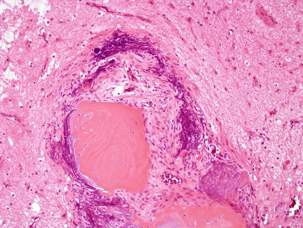 3A7 Calcifying Pseudoneoplasm Neuraxis (2009 CANP Unknown 12) H&E 4