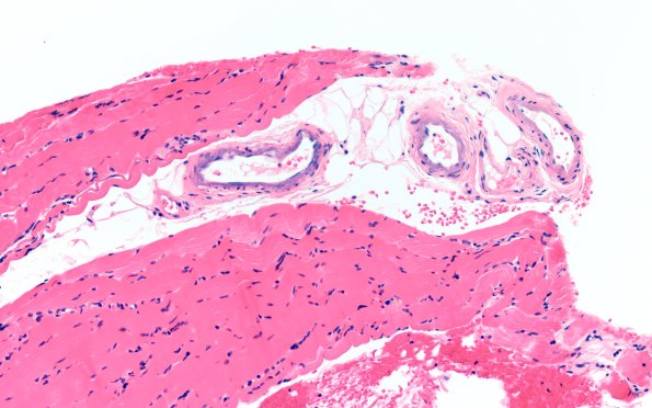 1A1 Calciphylaxis (Case 1) 20X 2