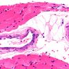 1A2 Calciphylaxis (Case 1) 40X 2