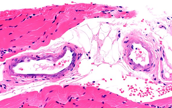 1A2 Calciphylaxis (Case 1) 40X 2