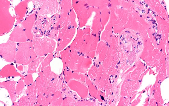 1A5 Calciphylaxis (Case 1) 40X 1