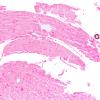 1B1 Calciphylaxis (Case 1) Von Kossa 10X 1