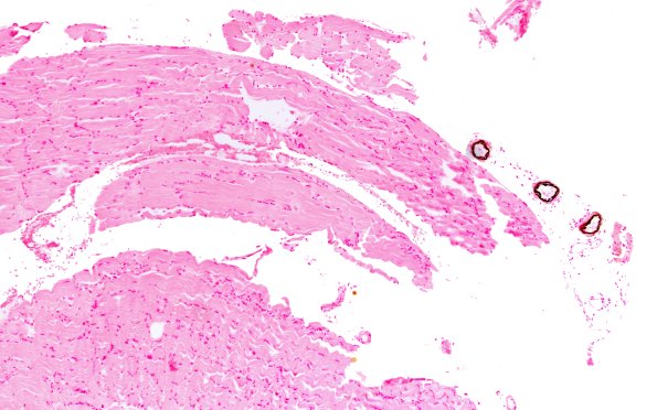 1B1 Calciphylaxis (Case 1) Von Kossa 10X 1