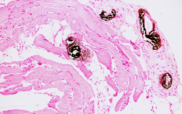 1B2 Calciphylaxis (Case 1) Von Kossa 20X 1