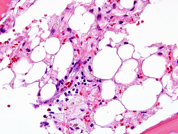 1A1 Hemophagocytic Lymphohistiocytosis (Case 1) BM H&E 5