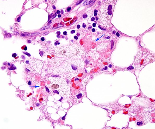 1A2 Hemophagocytic Lymphohistiocytosis (Case 1) BM H&E 100X 3 copy