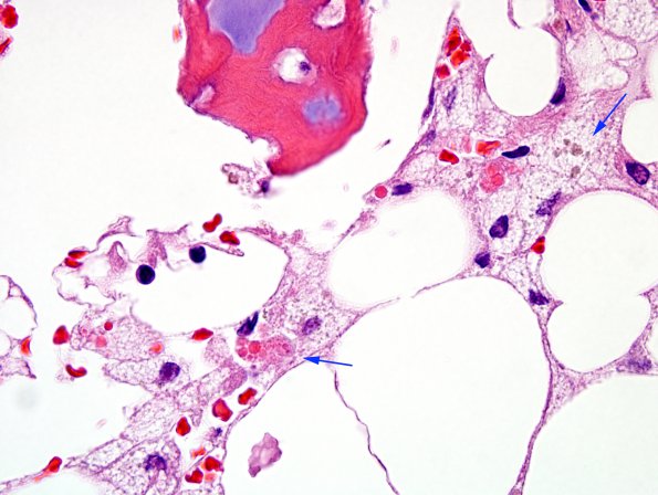 1A3 Hemophagocytic Lymphohistiocytosis (Case 1) BM H&E 100X 4 copy