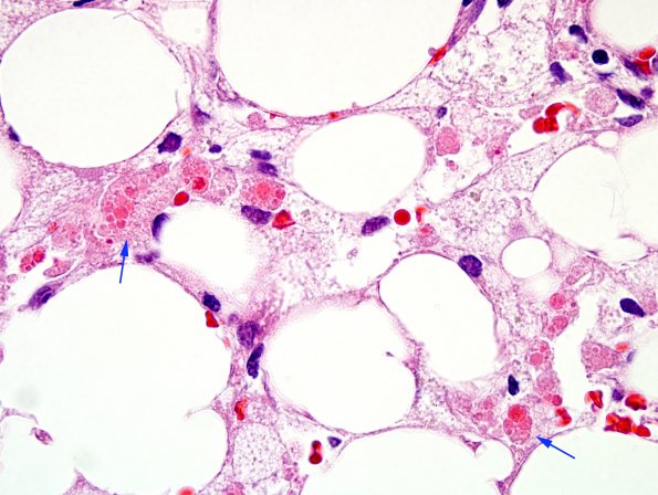 1A4 Hemophagocytic Lymphohistiocytosis (Case 1) BM H&E 100X 8 copy