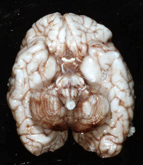 1B1 Familial Hemophagic lymphohisiocytosis (Case 1) _1