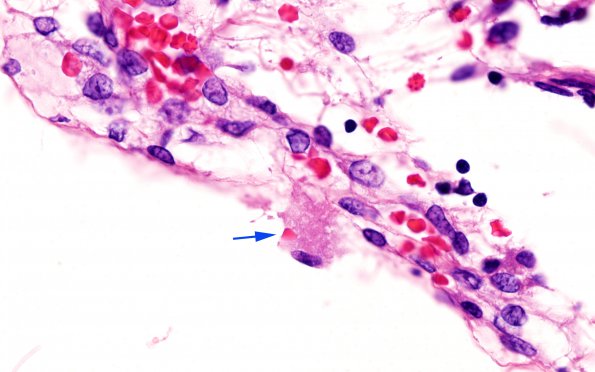 1B10 Familial erythrophagic lymphohistiocytosis (Case 1) N9 H&E new 1