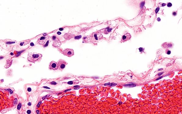 1B11 Familial erythrophagic lymphohistiocytosis (Case 1) N9 H&E new 4