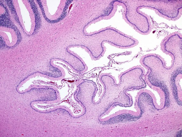 1B3 Familial erythrophagic lymphohistiocytosis (Case 1) N9 H&E 11.