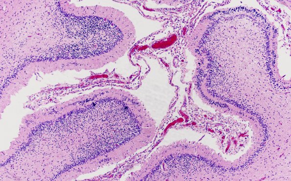 1B4 Familial erythrophagic lymphohistiocytosis (Case 1) N9 H&E 2A