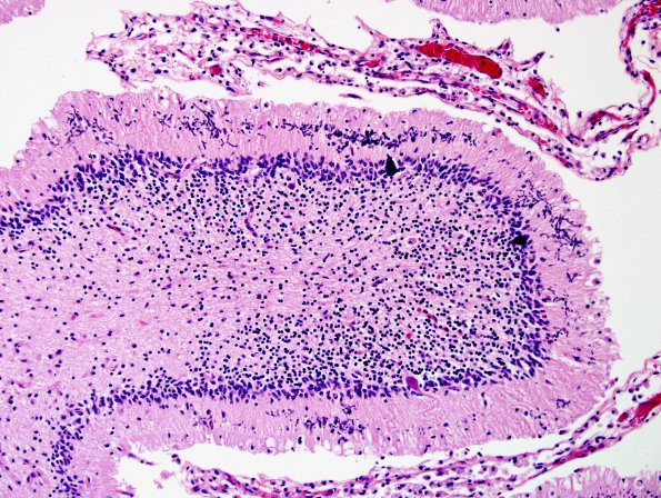 1B5 Familial erythrophagic lymphohistiocytosis (Case 1) no HIV N9 H&E 13