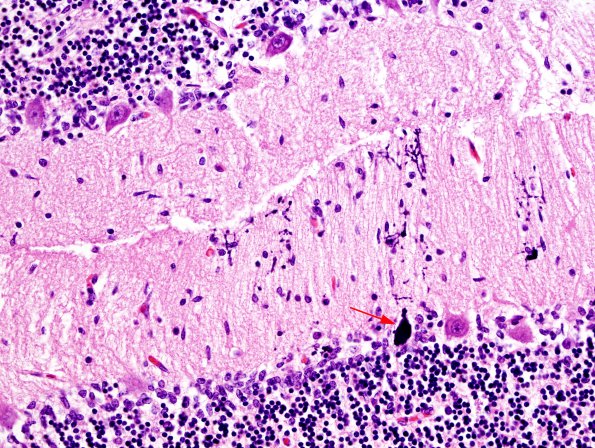 1B6 Familial erythrophagic lymphohistiocytosis (Case 1) N9 H&E 8 copy