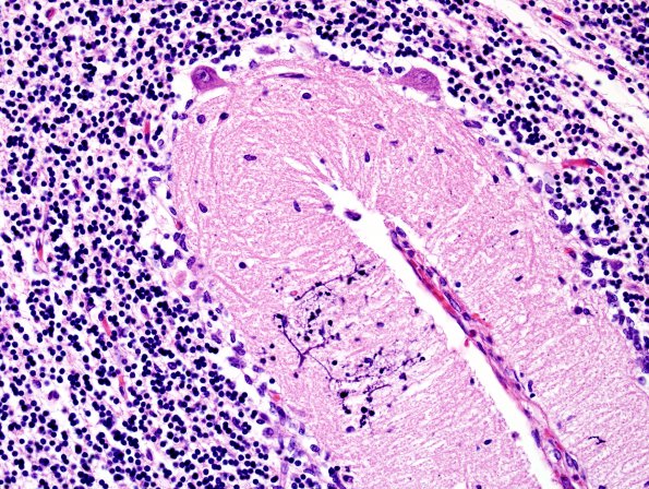 1B7 Familial erythrophagic lymphohistiocytosis (Case 1) N9 H&E 3a