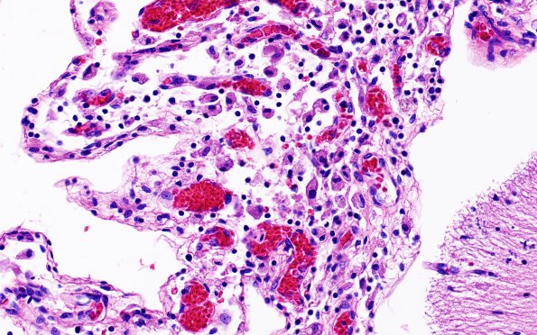 1B8 Familial erythrophagic lymphohistiocytosis (Case 1) N9 H&E 2