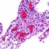 1B9 Familial erythrophagic lymphohistiocytosis (Case 1) N9 H&E 4