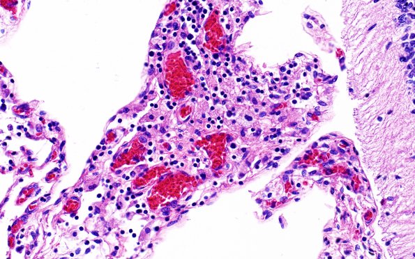 1B9 Familial erythrophagic lymphohistiocytosis (Case 1) N9 H&E 4