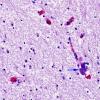 1C2 Familial erythrophagic lymphohistiocytosis (Case 1) no HIV N1 H&E 4