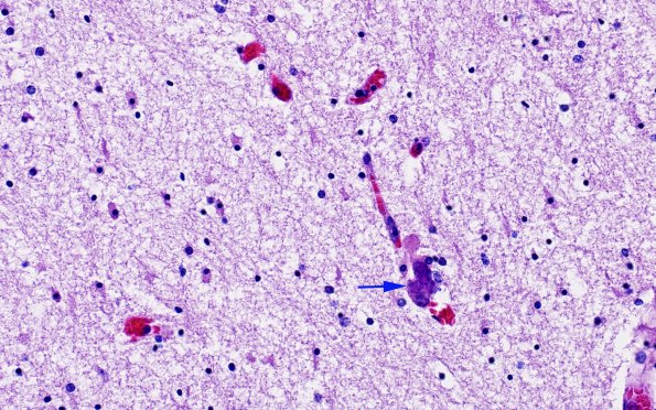 1C2 Familial erythrophagic lymphohistiocytosis (Case 1) no HIV N1 H&E 4