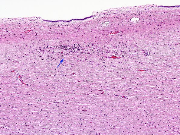 1C3 Familial erythrophagic lymphohistiocytosis (Case 1) N11 H&E 1 copy.