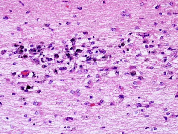 1C4 Familial erythrophagic lymphohistiocytosis (Case 1) N2 H&E 11